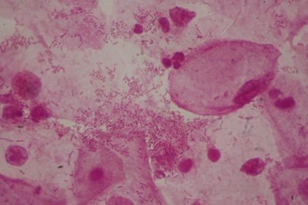 infections vaginales vaginite escherichia coli