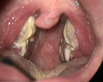 mononucléose infectieuse