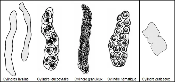 ECBU schéma des cylindres urinaires